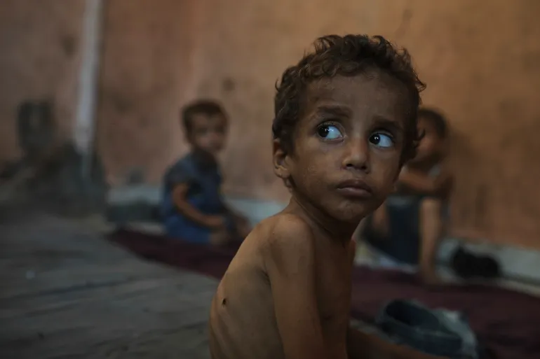 ما يزيد عن 80 طفل توفي إثر التجويع والحصار في غزة